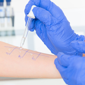 Patient undergoing Skin Prick Allergy Testing